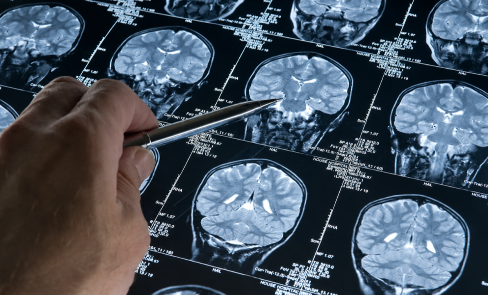El Alzheimer comienza mucho antes del primer olvido revela la ciencia